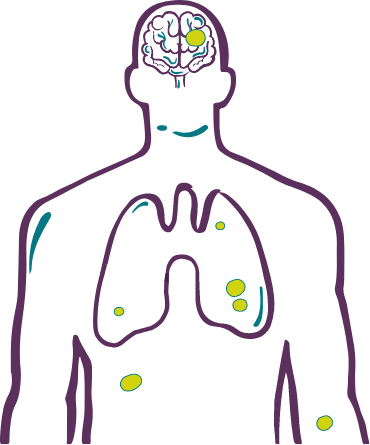 Metastatic recurrence in NSCLC body graphic