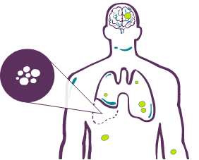 Most Common Sites of Metastasis After Resection in NSCLC